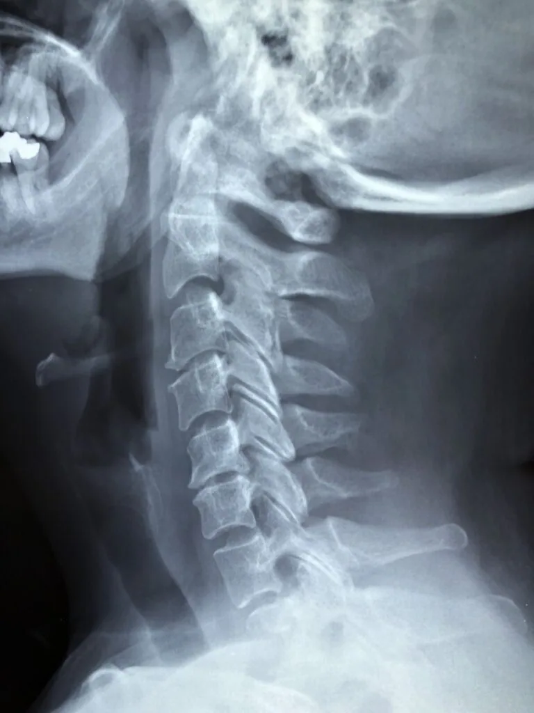 X-ray of cervical spine showing vertebrae and neck structure from lateral view